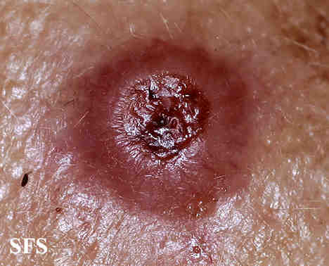 melanoma